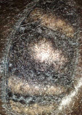 African American Hair: Dry Scalp Treatment